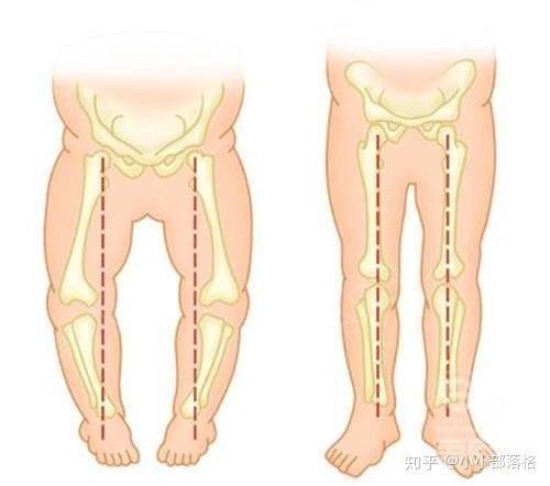 O型腿矫正方法，科学有效的治疗与改善策略  o型腿矫正方法